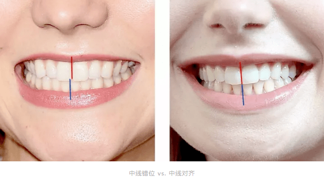 牙齿明明很整齐,为什么笑起来不好看?_中线