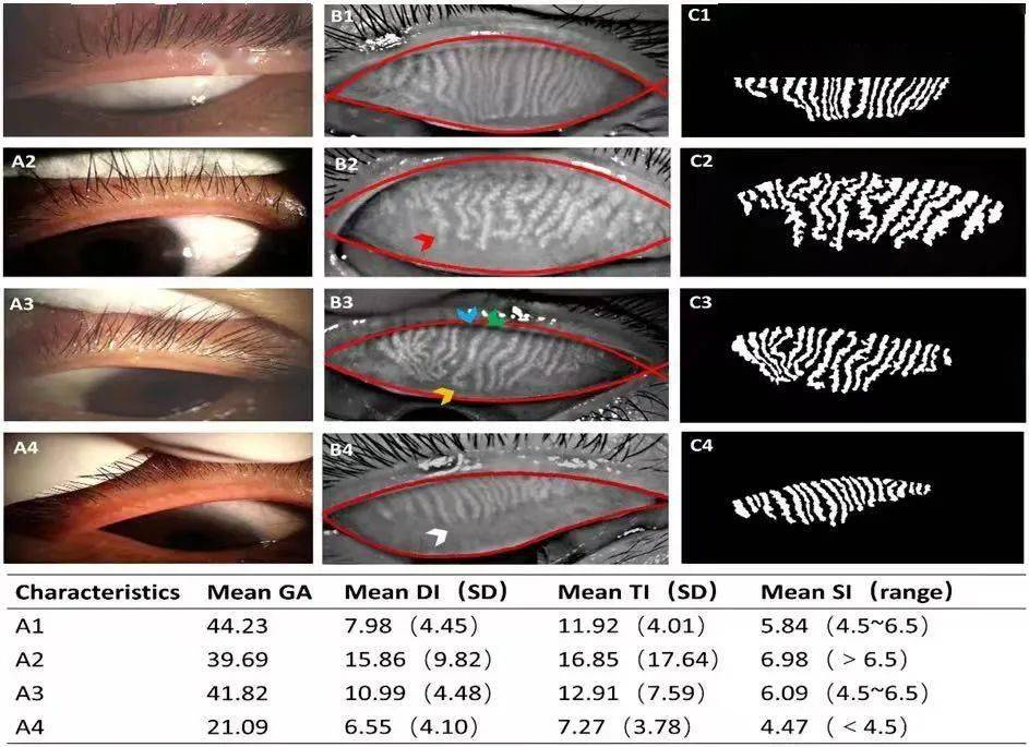 袁进教授团队自主研发智能睑板腺分析系统!已发表于《柳叶刀》子刊