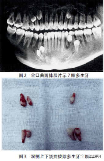 7颗多生牙报道1例及文献复习_下颌