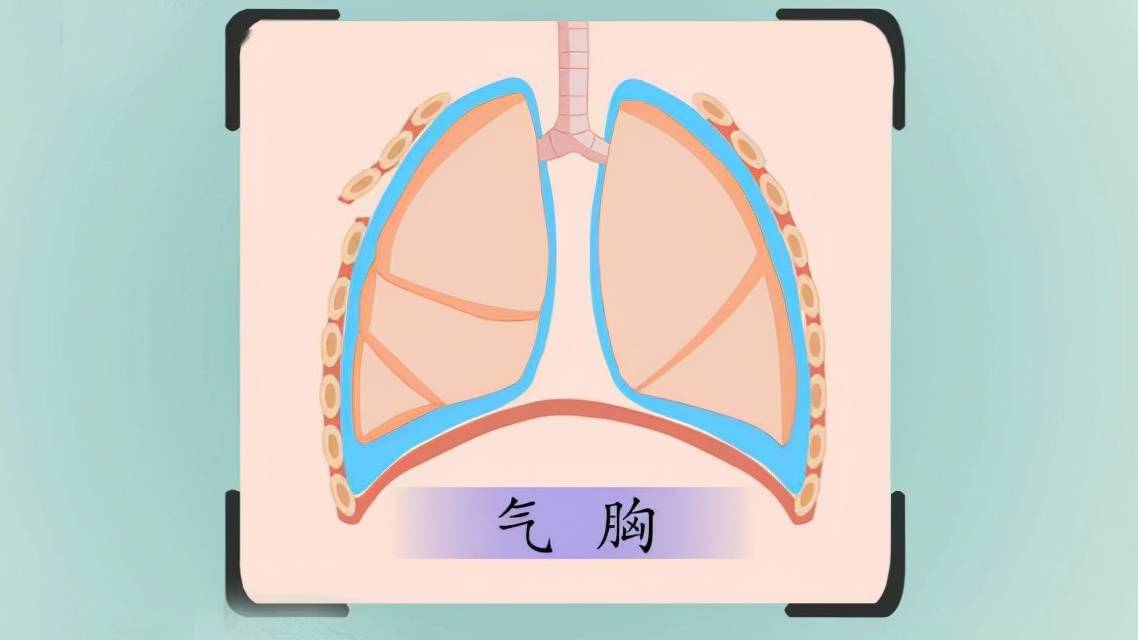 17岁女生突发胸痛患气胸 或与军训劳累有关