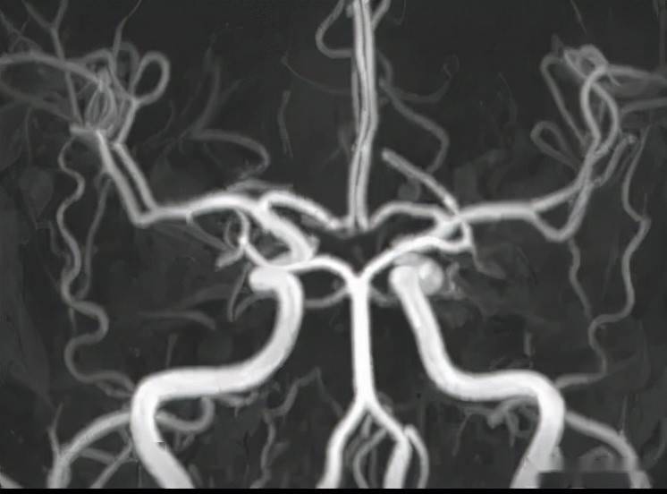 头颅mra未见颅内异常血管,但头颅mri-tof像可见左侧天幕缘异常血管影