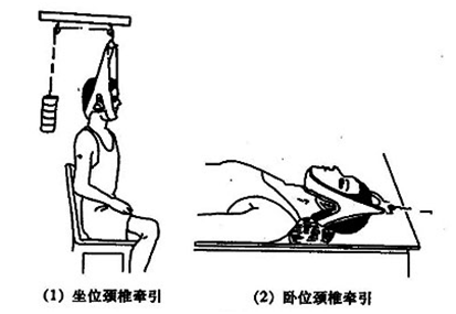 吊着脖子做着牵引痛苦地不能动弹;在大多数人的印象里,颈椎病是老年人