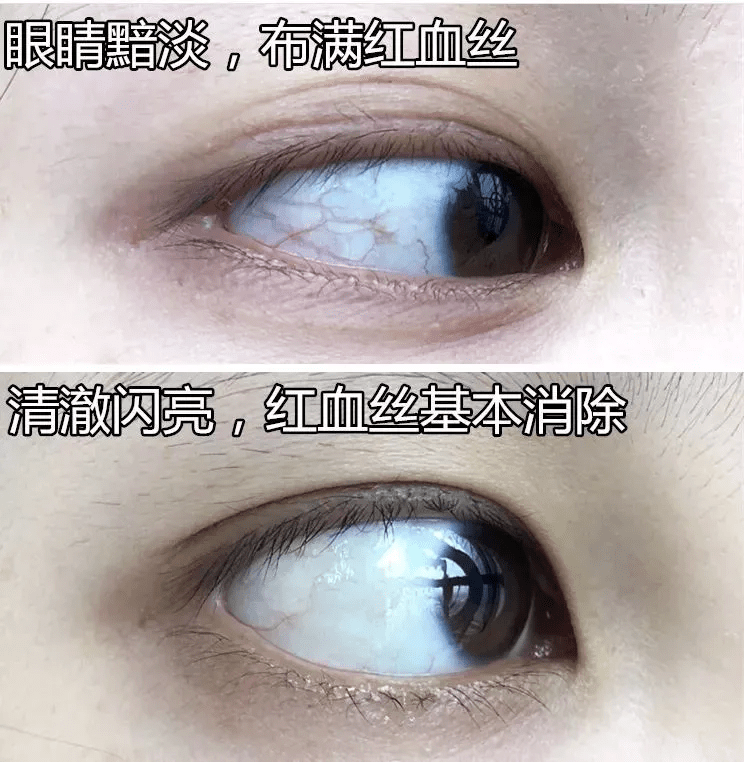 ""随着年龄增长,眼球表面会形成一层发黄的脂肪膜,也就是我们常说的