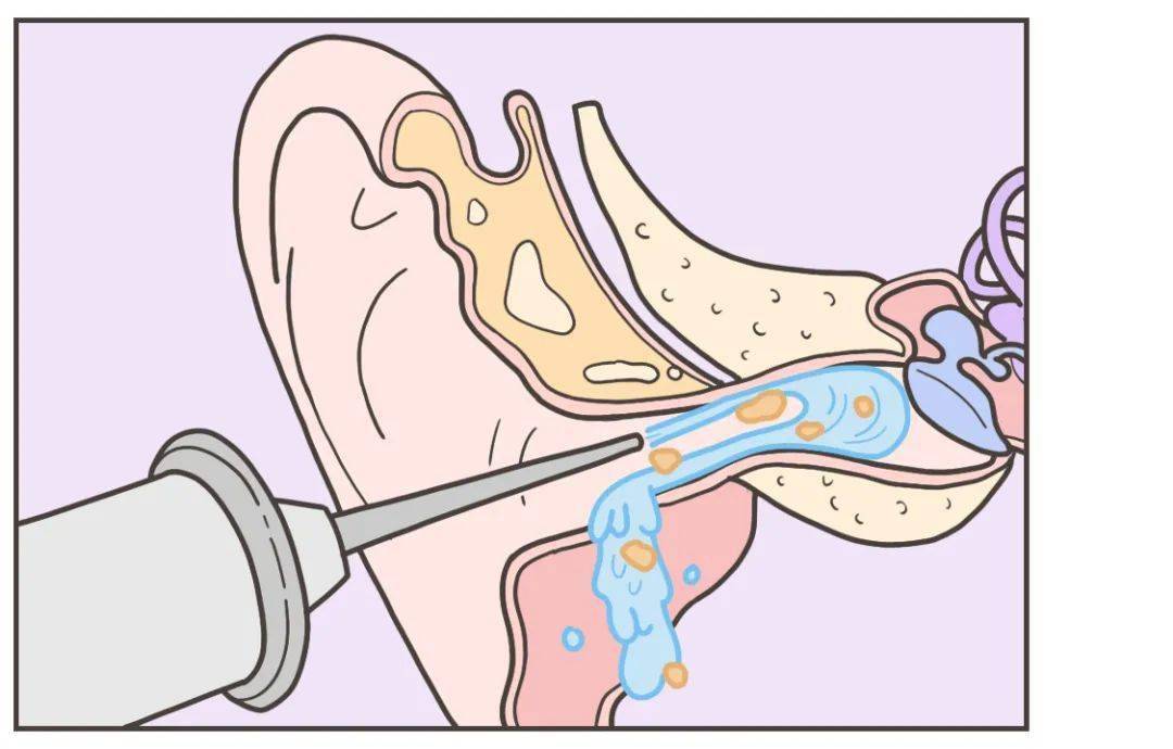 耳屎 推向耳道更深处 很多人不知道 实际上医院会提供外耳道冲洗服务