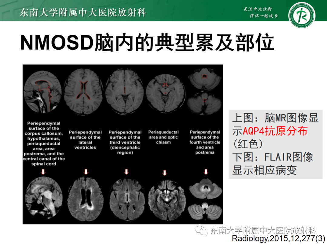 wernicke脑病影像表现