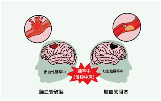 是脑血管在某一部位突然破裂或阻塞而引起的疾病包括缺血性卒中和