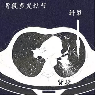 4.病灶分布广,左肺右肺都有3.小结节沿着支气管播散2.