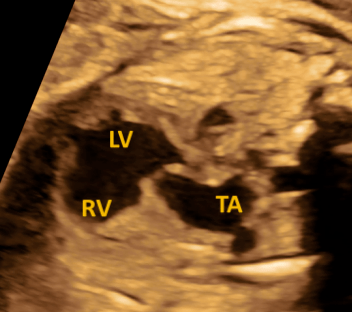 永存动脉干的胎儿超声心动图诊断