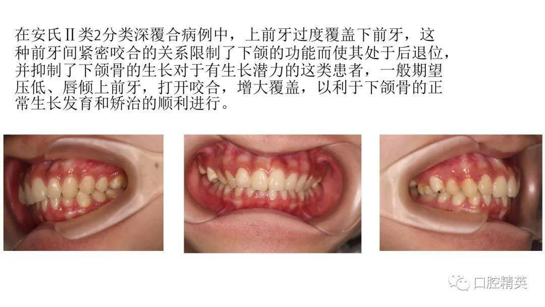 正畸临床打开咬合的方法