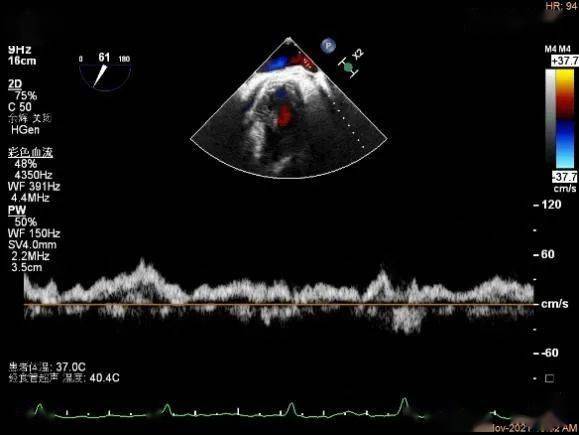 肺静脉血流频谱逐渐恢复正向,后测量平均跨瓣压差:2mmhg