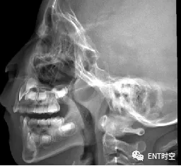 鼻咽部侧位x片的摄片方法 患儿端坐或站立侧位,下颌略抬高,以减少下颌