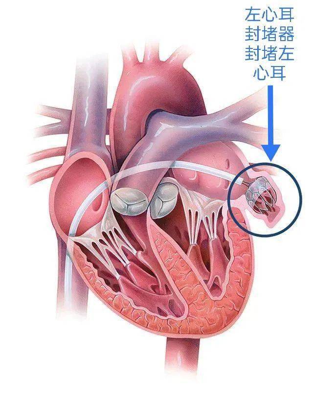 左心耳封堵术是什么?这技术的河源空白就这么被省医河源填补了