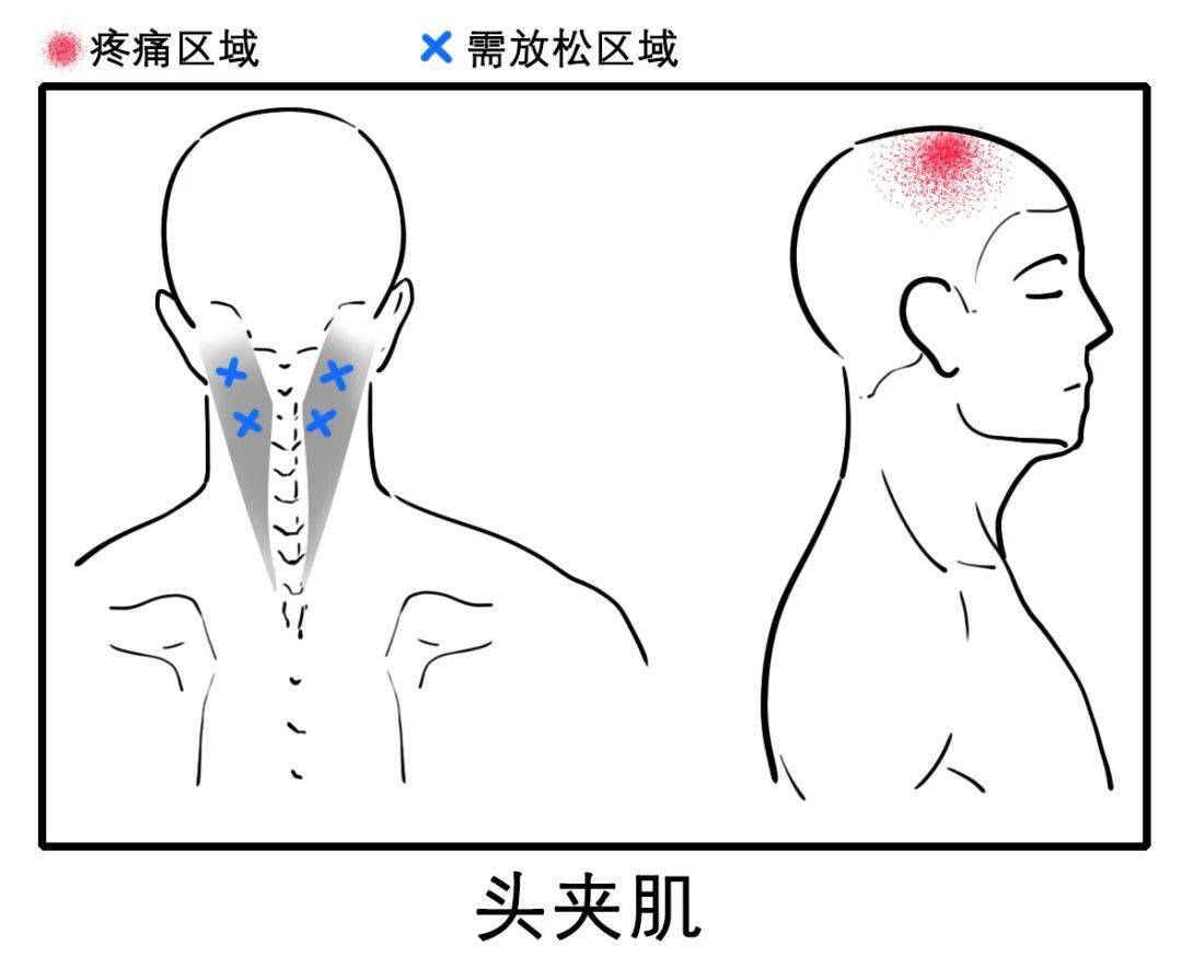 对照"头痛部位图"轻松缓解_颈源_症状_颈部