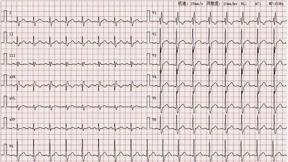 心电图库丨完全性右束支阻滞系列