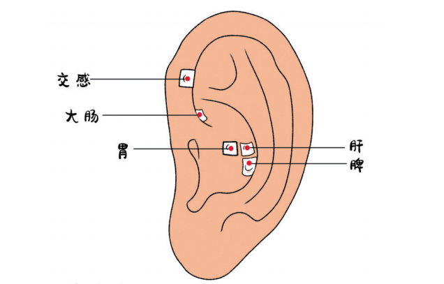 耳穴压豆,取大肠,脾,胃,肝,交感反射区,每日间断揉搓按摩.