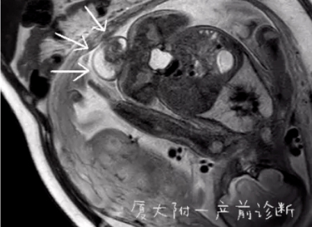 第一医院产前诊断多学科专家团队临床组,超声组,核磁共振组,遗传组,儿