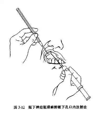 又叫腭大孔注射法(5)鼻腭神经阻滞麻醉(6)下颌神经阻滞麻醉(7)下牙槽