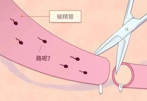 情人节必读:特别的科普,给特别的你_避孕_女性_上环