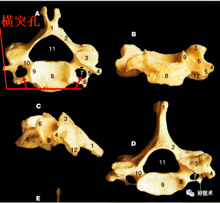 横突孔:位于横突根部,距椎体侧缘(钩突)较近,其内有椎动脉,椎静脉和