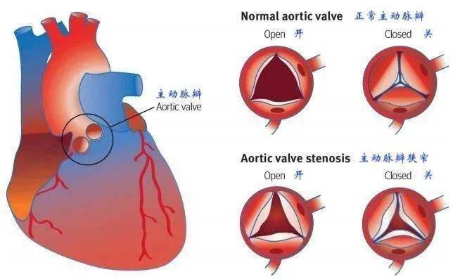 中医科普 瓣膜反流说明什么,定期复查别忘了_二尖瓣_心脏_主动脉