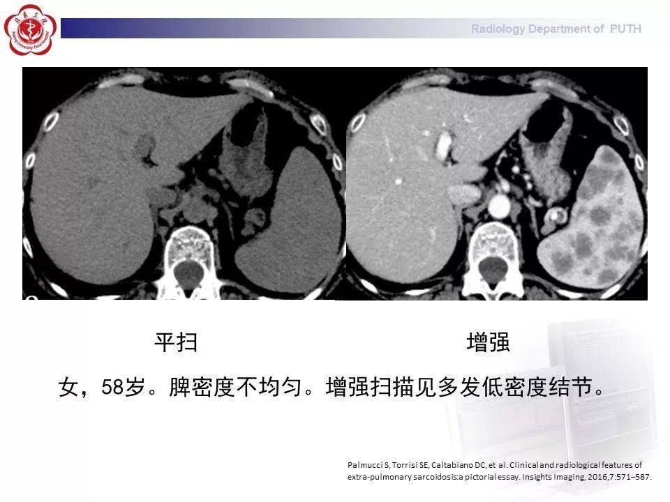 结节病的影像表现