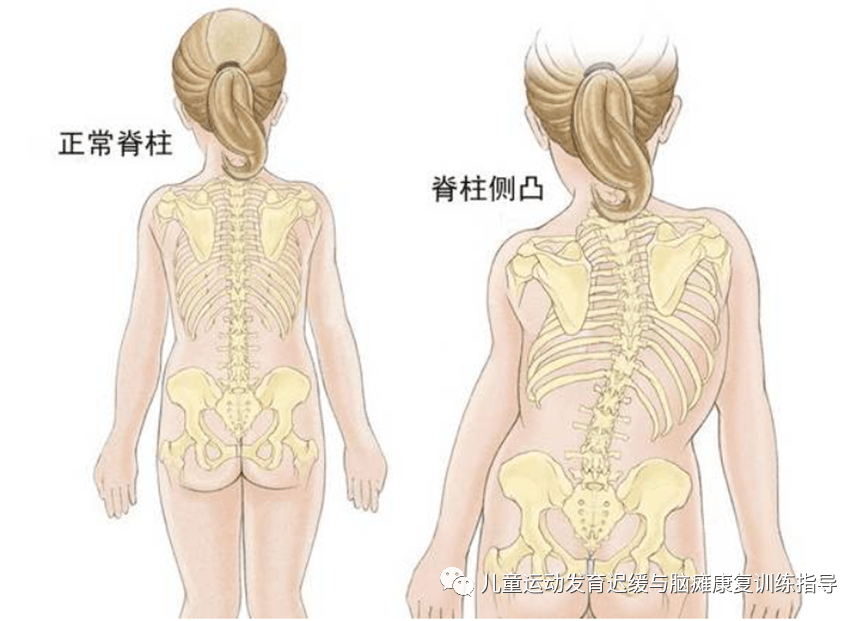 家长科普专栏 | 脊柱侧凸分型训练方法_进行_儿童_宝宝