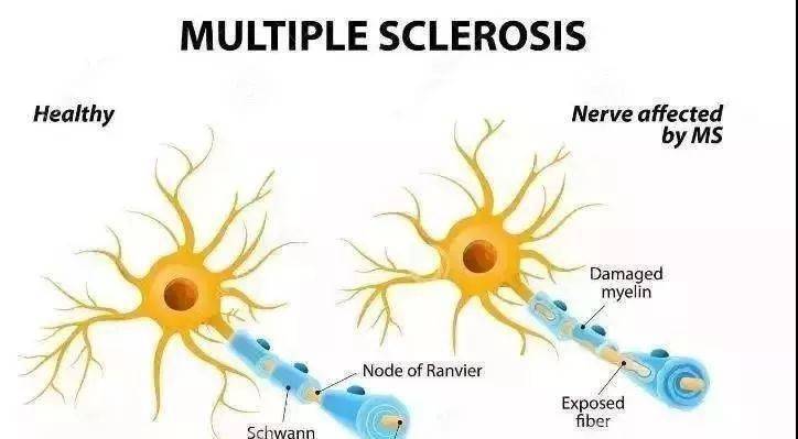 美女病 多发性硬化症MS爱向中青年仙女下毒手干细胞技术带来新希望 患者 治疗 症状