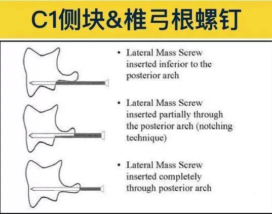 收藏丨胸椎颈椎腰椎椎弓根置钉技术