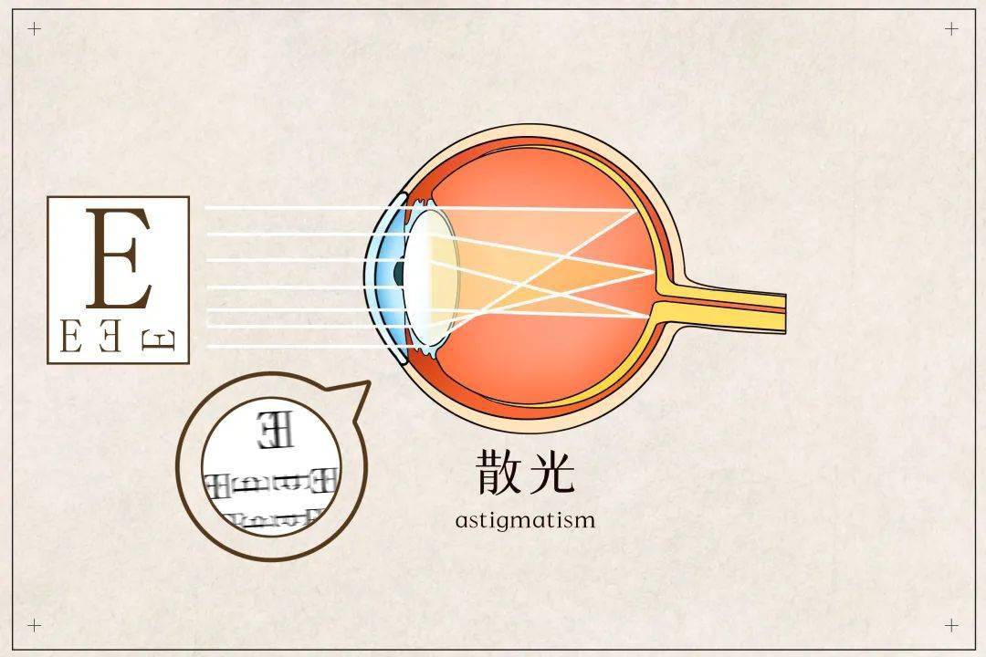 双眼近视加散光这种矫正方式很方便