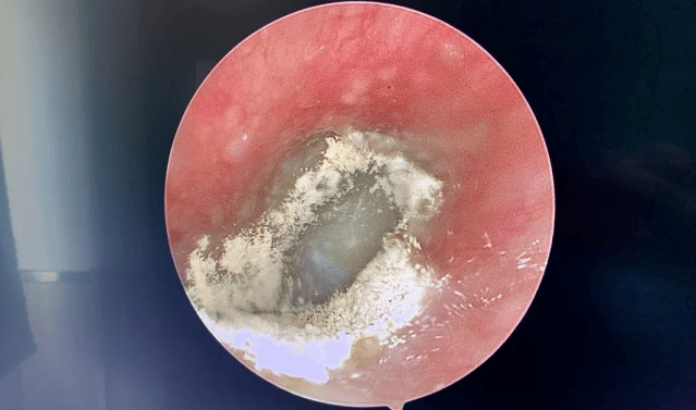 喜欢采耳当心真菌性外耳道炎找上门