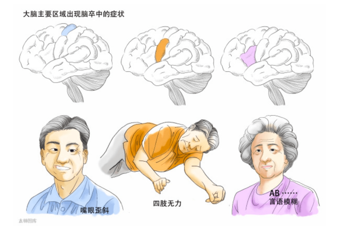 很可能留下肢体瘫痪,语言障碍,吞咽困难,认知障碍,焦虑或抑郁等后遗症