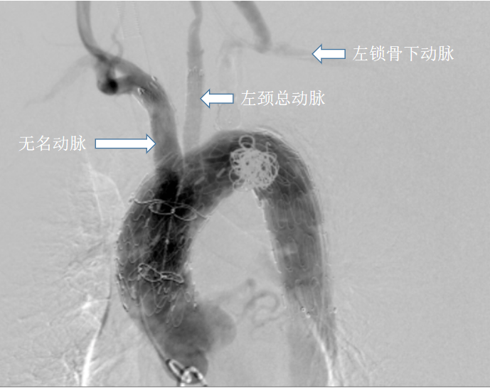 释放并重建无名动脉和左颈总动脉经术前造影显示与cta测量结果一致