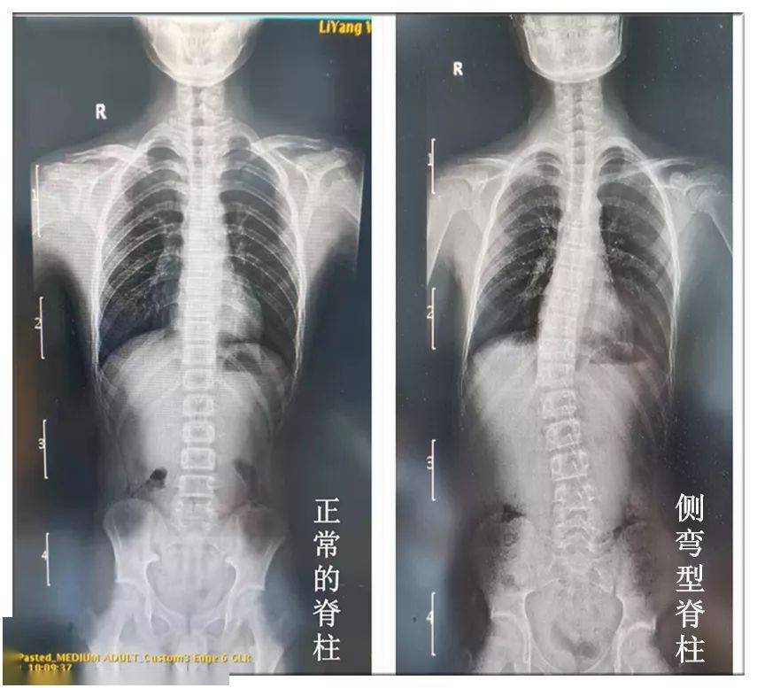 关节囊等软组织处于一种自然充分放松,休息状态,有利于脊柱的健康