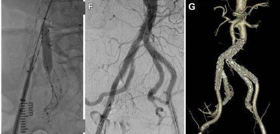 髂内动脉腔内重建的意义及最新文献解读_支架_血管