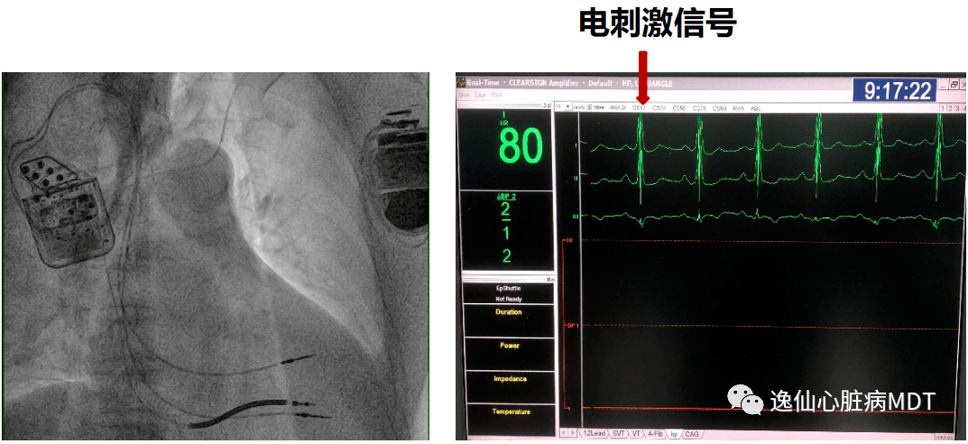 反复心衰住院 15 次,nt-probnp 4091 pg/ml,如何救治?_mmhg_治疗_qd