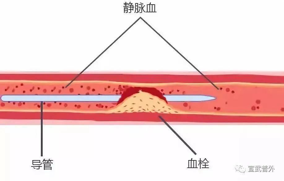 picc导管相关性血栓是利用导管从外周手臂的静脉进行穿刺,导管直达上