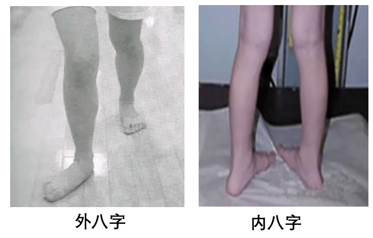 4种足踝异常肌力分析