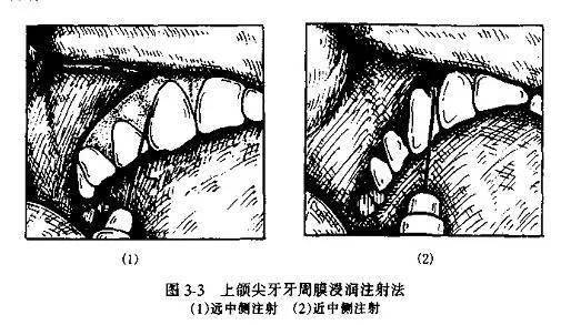 (1)上颌神经阻滞麻醉 上颌神经出圆孔