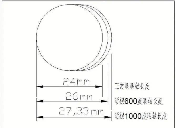 我们介绍了散瞳验光,这里,我们就可以通过检查孩子的眼轴/角膜曲率