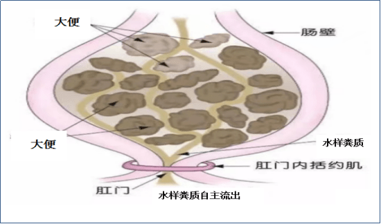 直肠_患者_粪便