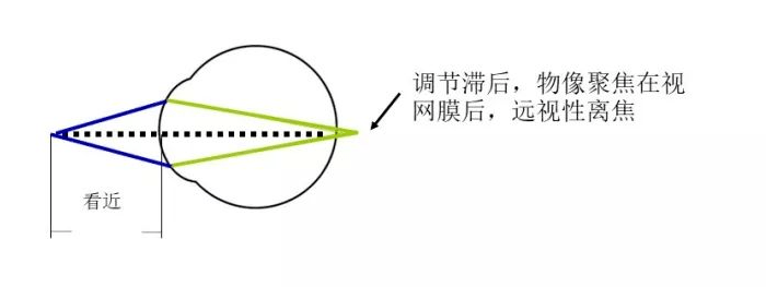 微透离焦镜片的原理_透镜_成像_视网膜