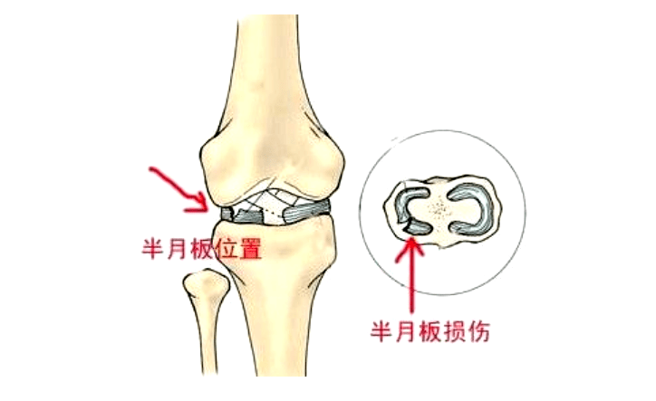 4 半月板损伤后有哪些症状表现?有无膝关节内其它结构的损伤?