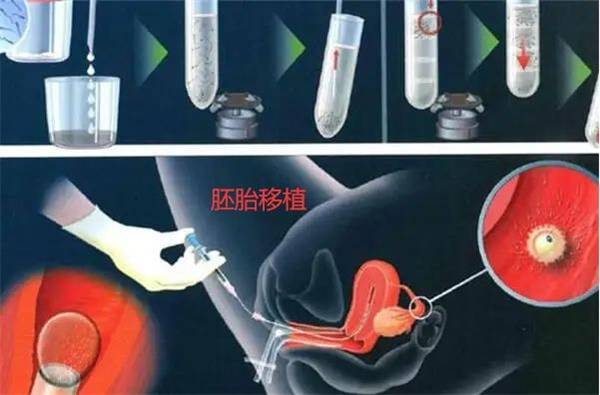 广州知名助孕公司（试管婴儿：胚胎移植后是坐飞机好还是高铁好）