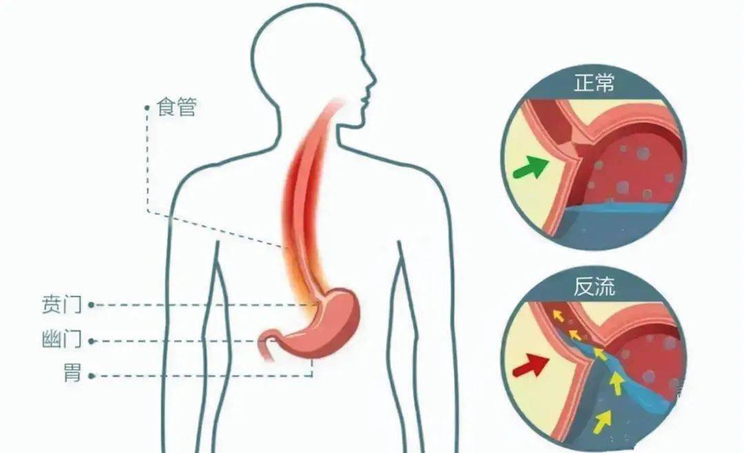 内镜室主任蒋冬梅:少为人知的咳嗽原因 胃食管反流病_医生_患者_食道