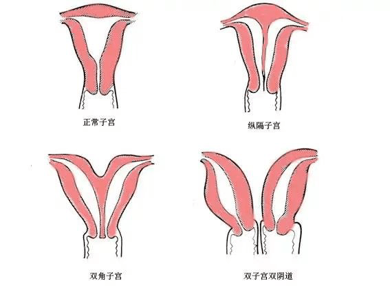 双侧副中肾管会合而完全未融合,各自发育便形成了两个子宫和两个宫颈
