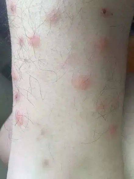 蚊子居然有“头发”？