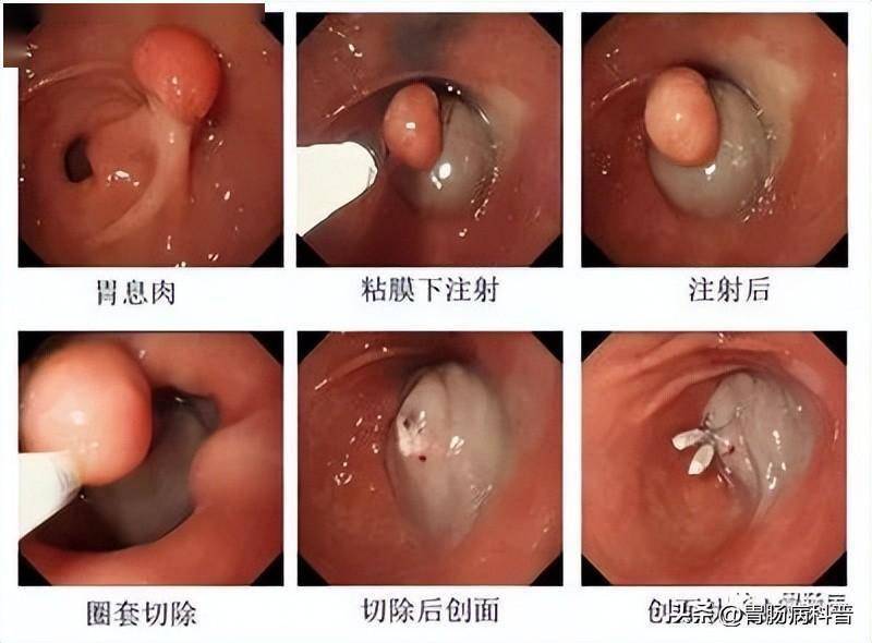 发现胃息肉，到底要不要切除？