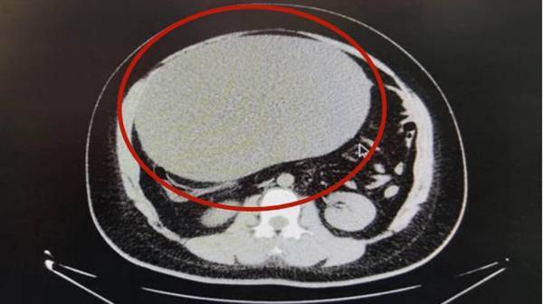 女子以为发胖肚中取出16斤囊肿？中医提醒卵巢健康需警惕！
