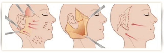 面部筋膜提升（筋膜提升是怎么做的）