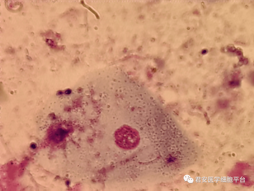 诊断及建议：1、涂片见大量细菌真菌和脂肪小球，可见上皮细胞，考虑为食